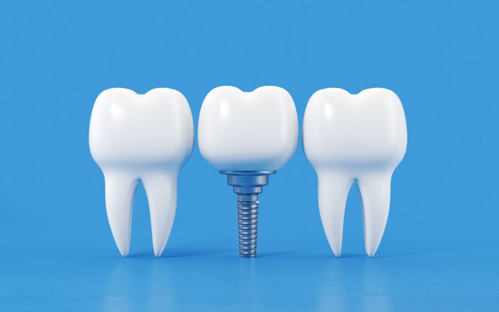 Advantage of implants over other tooth restoration